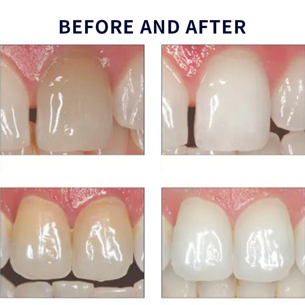 Opalescence Whitening 20% PF 2 - Teeth Whitening With Hydrogen Peroxide recensione e prezzo