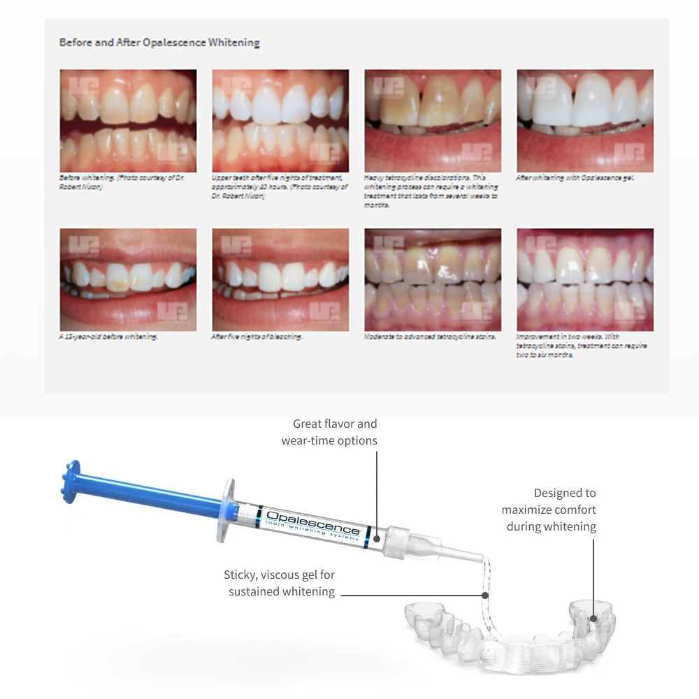 Opalescence Whitening 20% PF 2 - Teeth Whitening With Hydrogen Peroxide recensione e prezzo