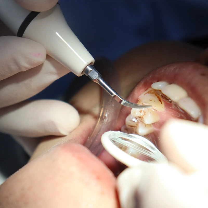 Cavo del tubo del manipolo del - Teeth Whitening Youtube recensione e prezzo