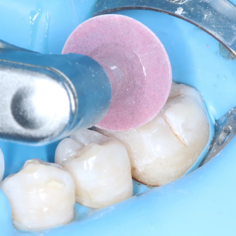 40 Pezzi Dischi Lucidanti Dent - Whitening Teeth Dentist recensione e prezzo