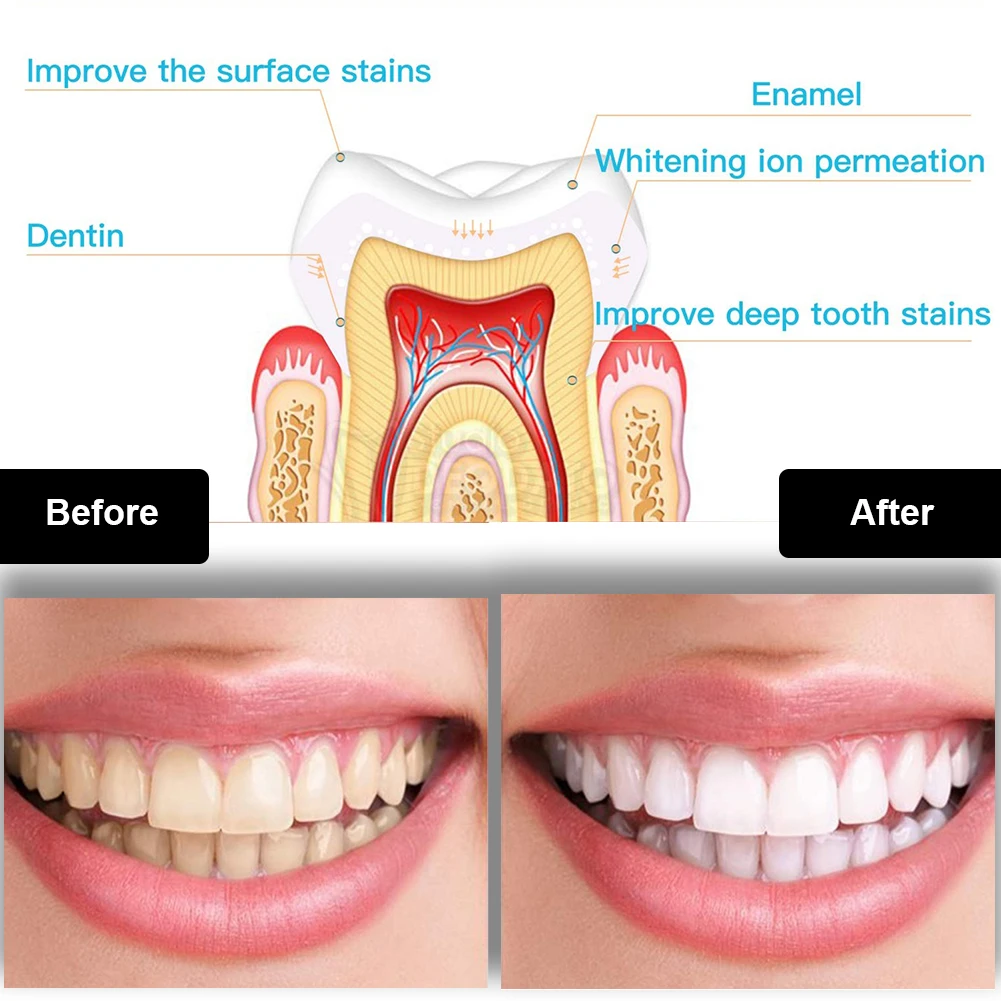 Kit per sbiancamento dei denti - Teeth Whitening With Hydrogen Peroxide recensione e prezzo