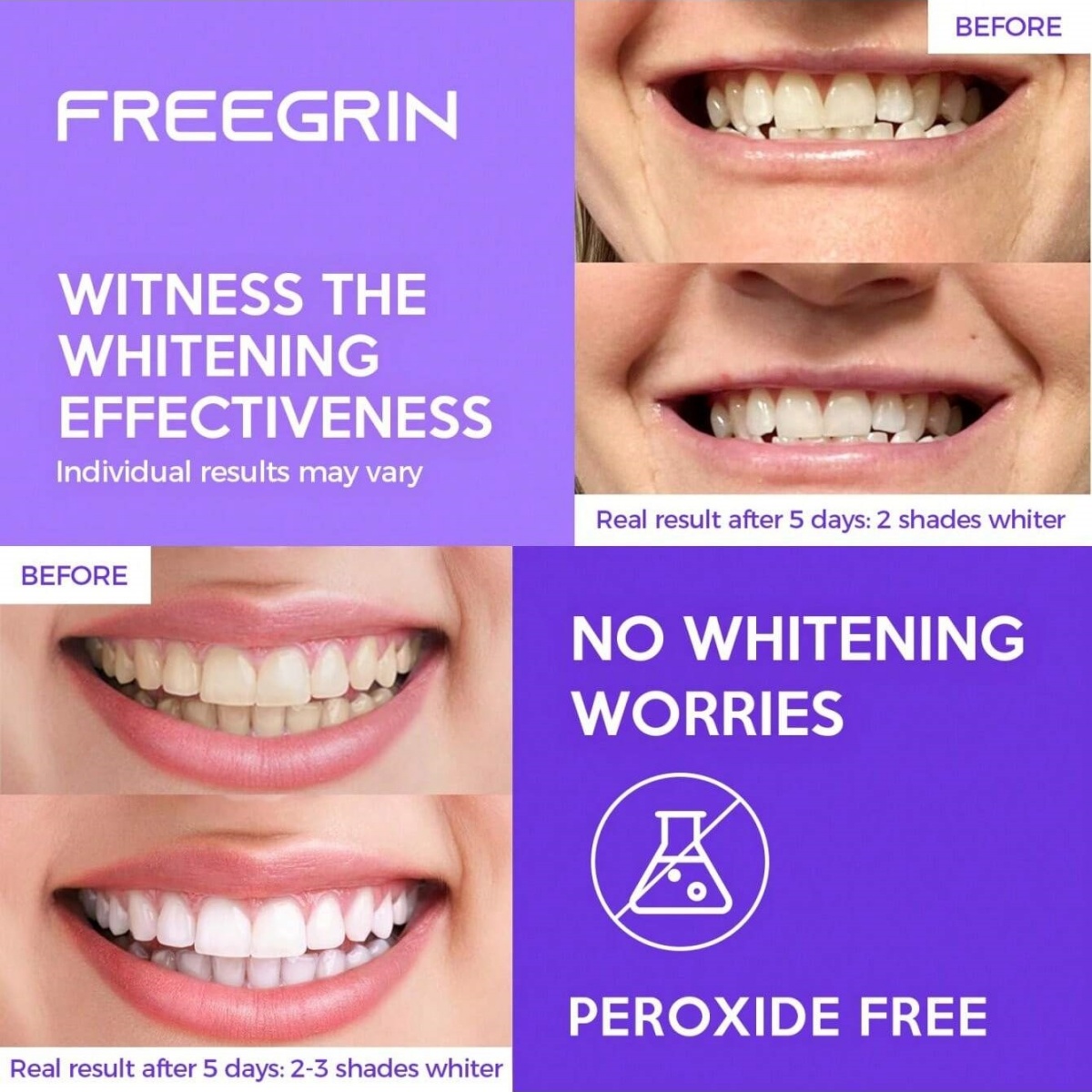 Adesivi sbiancanti per denti d - Teeth Whitening With Hydrogen Peroxide recensione e prezzo